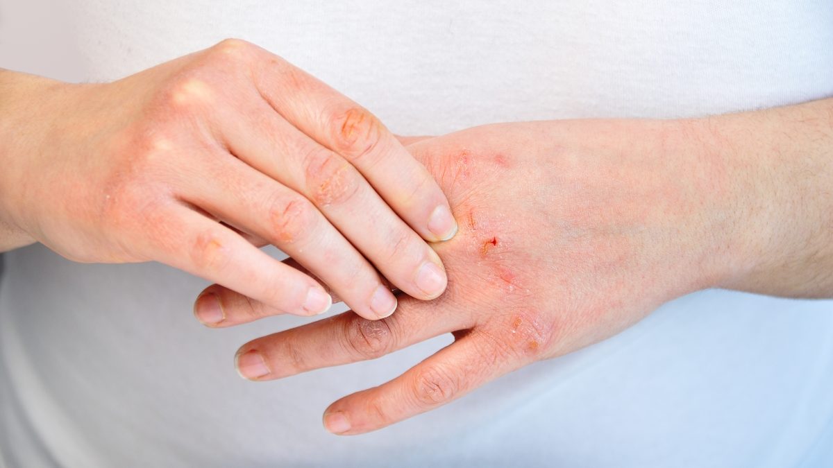 Atopic Dermatitis Eczema Causes Symptoms Treatments And Medications