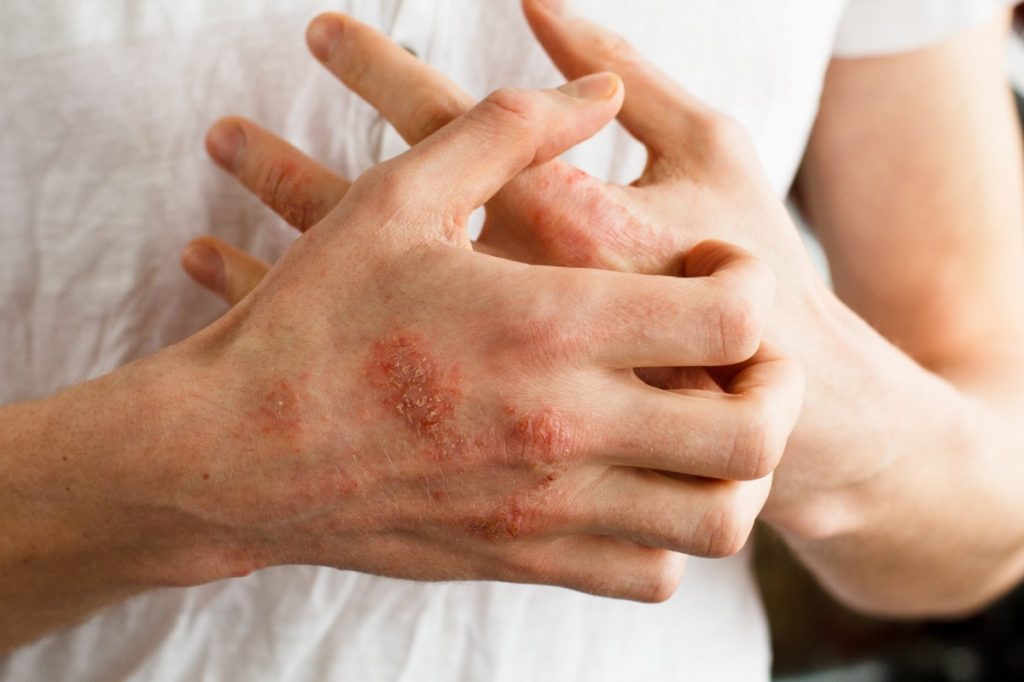 How to Identify and Avoid Latex Allergy Triggers –