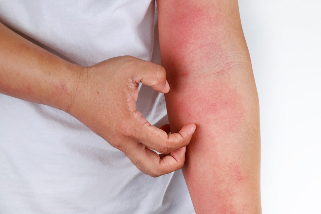 anaphylaxis rash